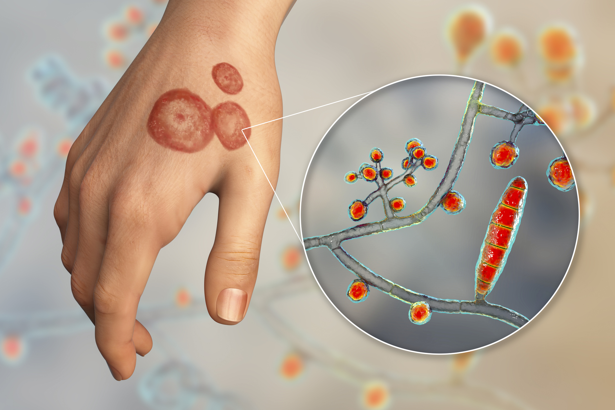 Syndrome uvéoméningoencéphalique