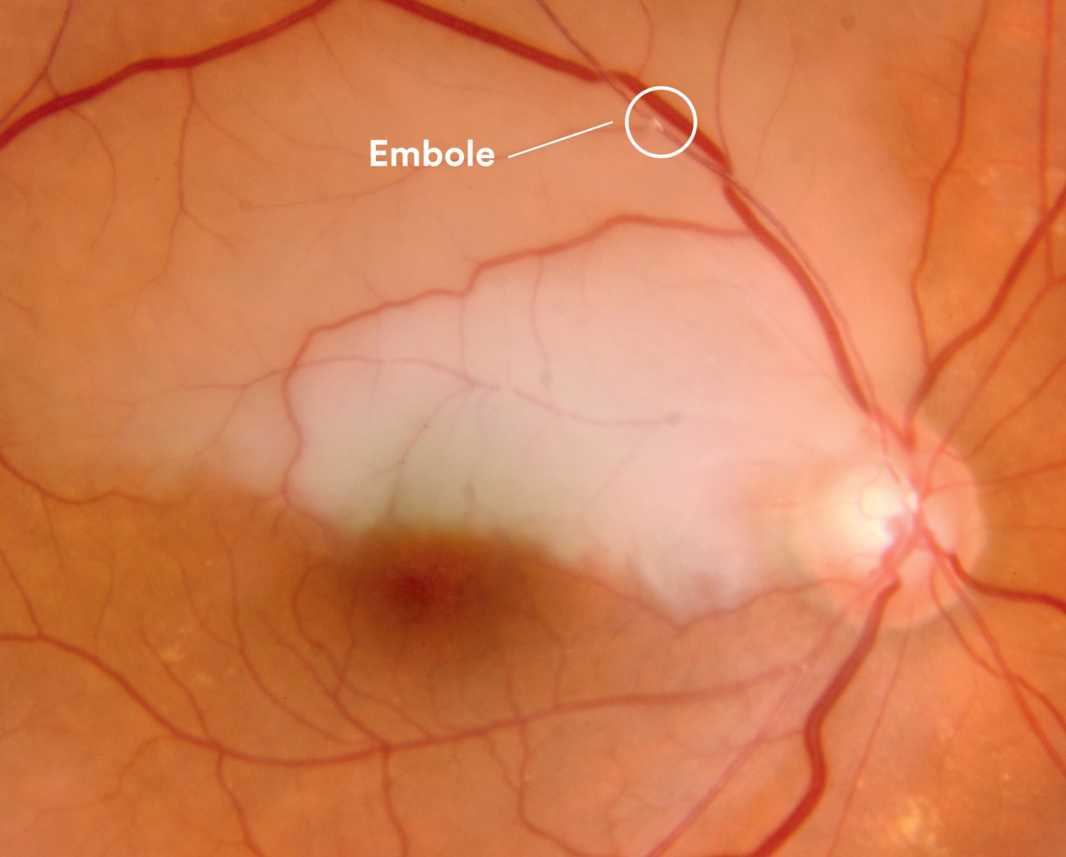 Stroke of the eye