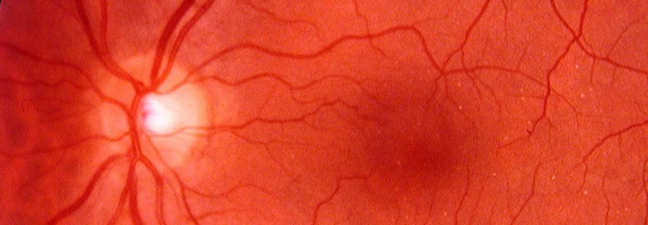 Retinal Neovascularization