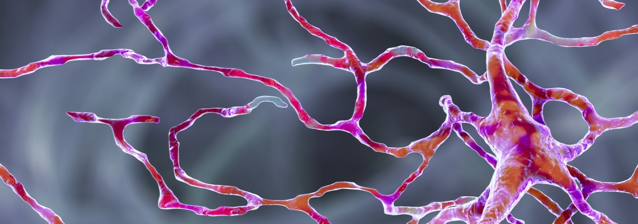 Posterior Ischaemic Optic Neuropathy (NOIA)