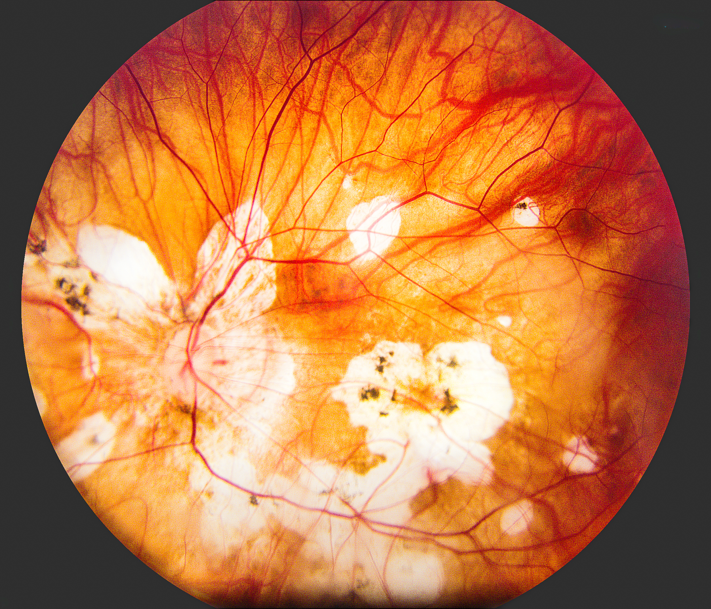 Glioma del nervio óptico