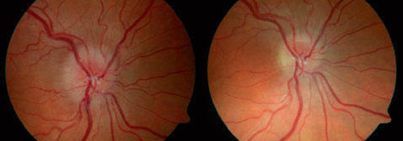 Optic Atrophy