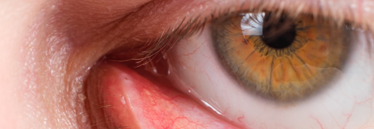 Infections bactériennes de l'oeil