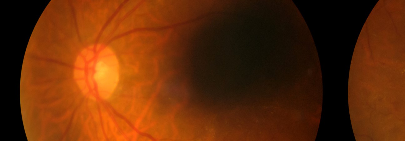 Retinal Perforations