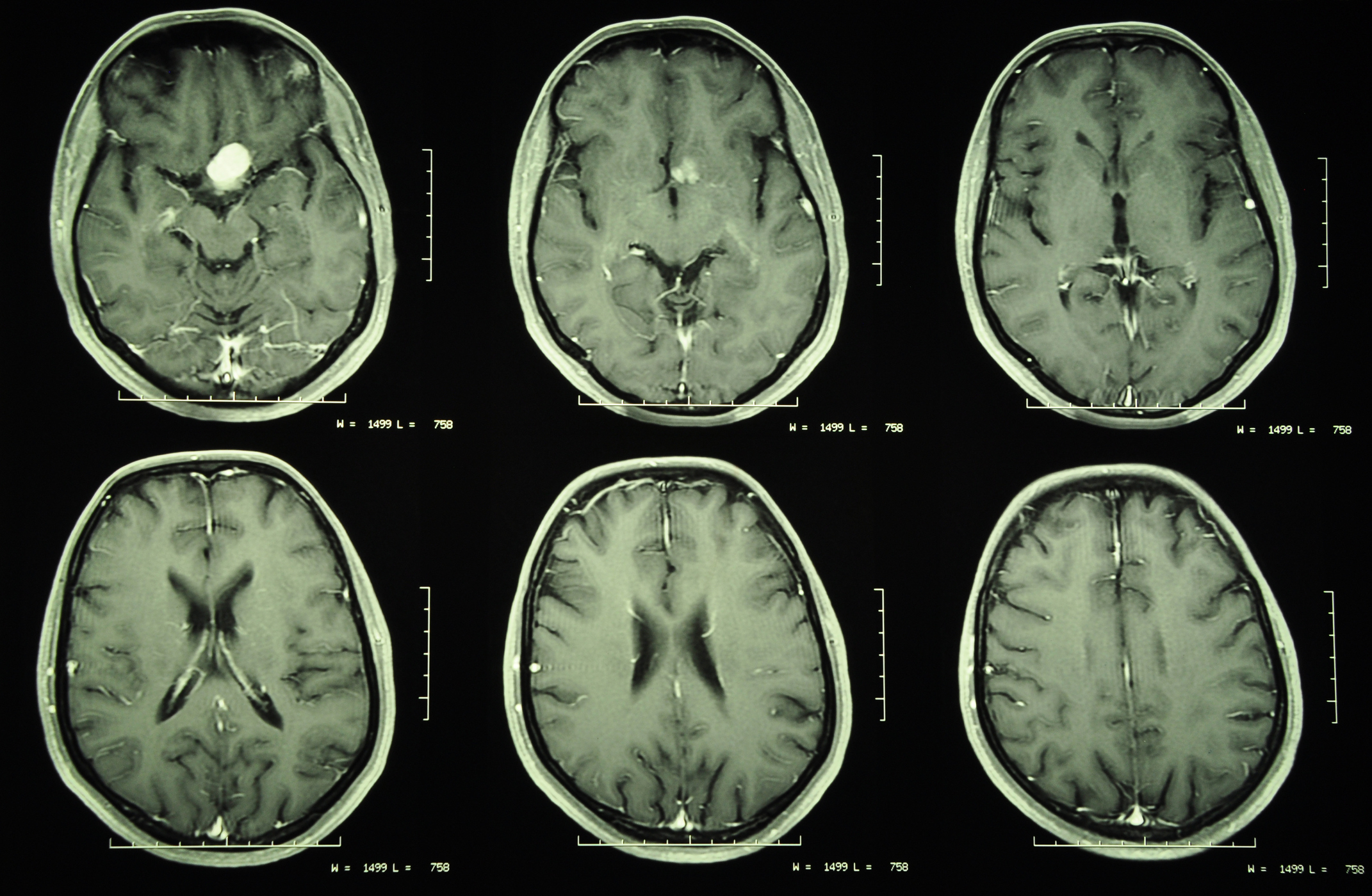 Optic Nerve Neoplasms