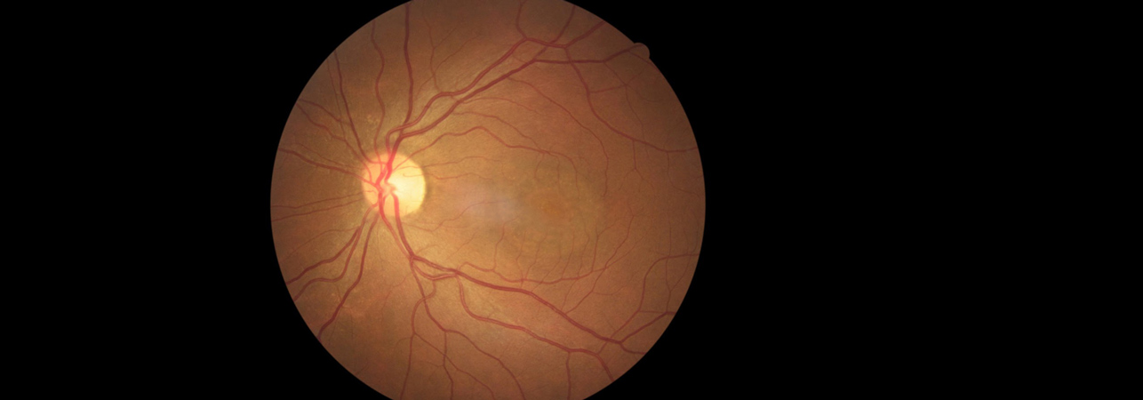 Coriorretinitis