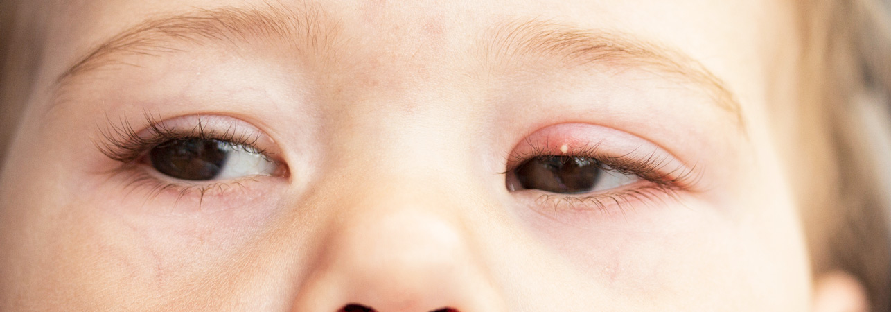 Gonococcal conjunctivitis in newborns