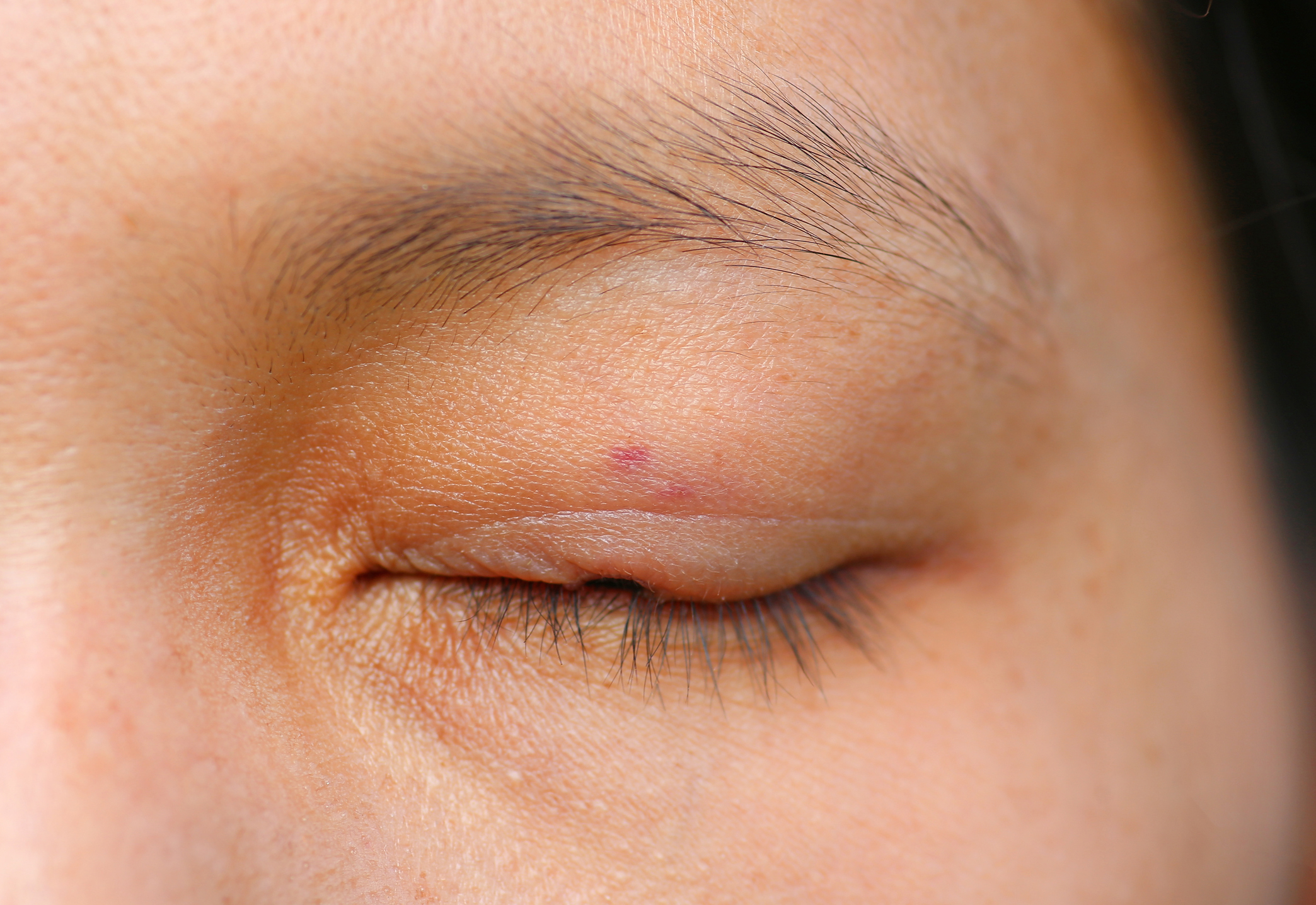 Eyelid tumour