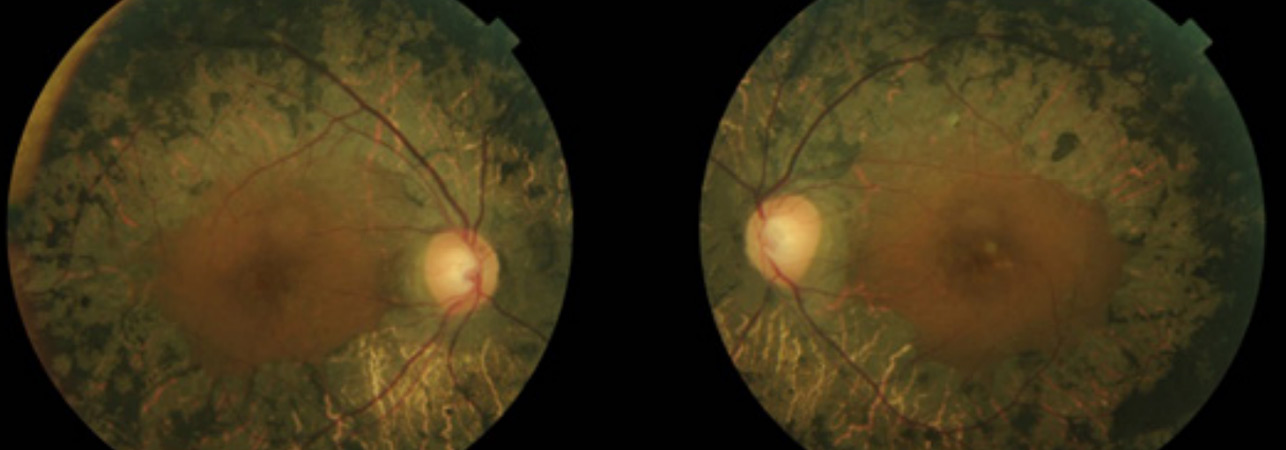 Chorioretinal gyri atrophy