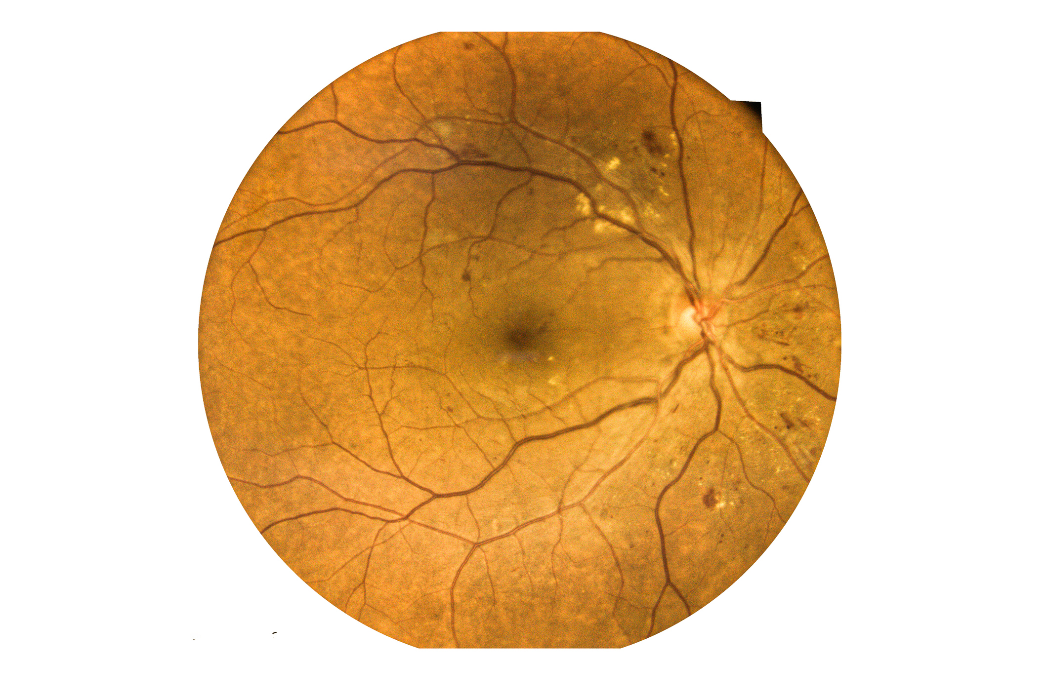 Estrias angióides da retina