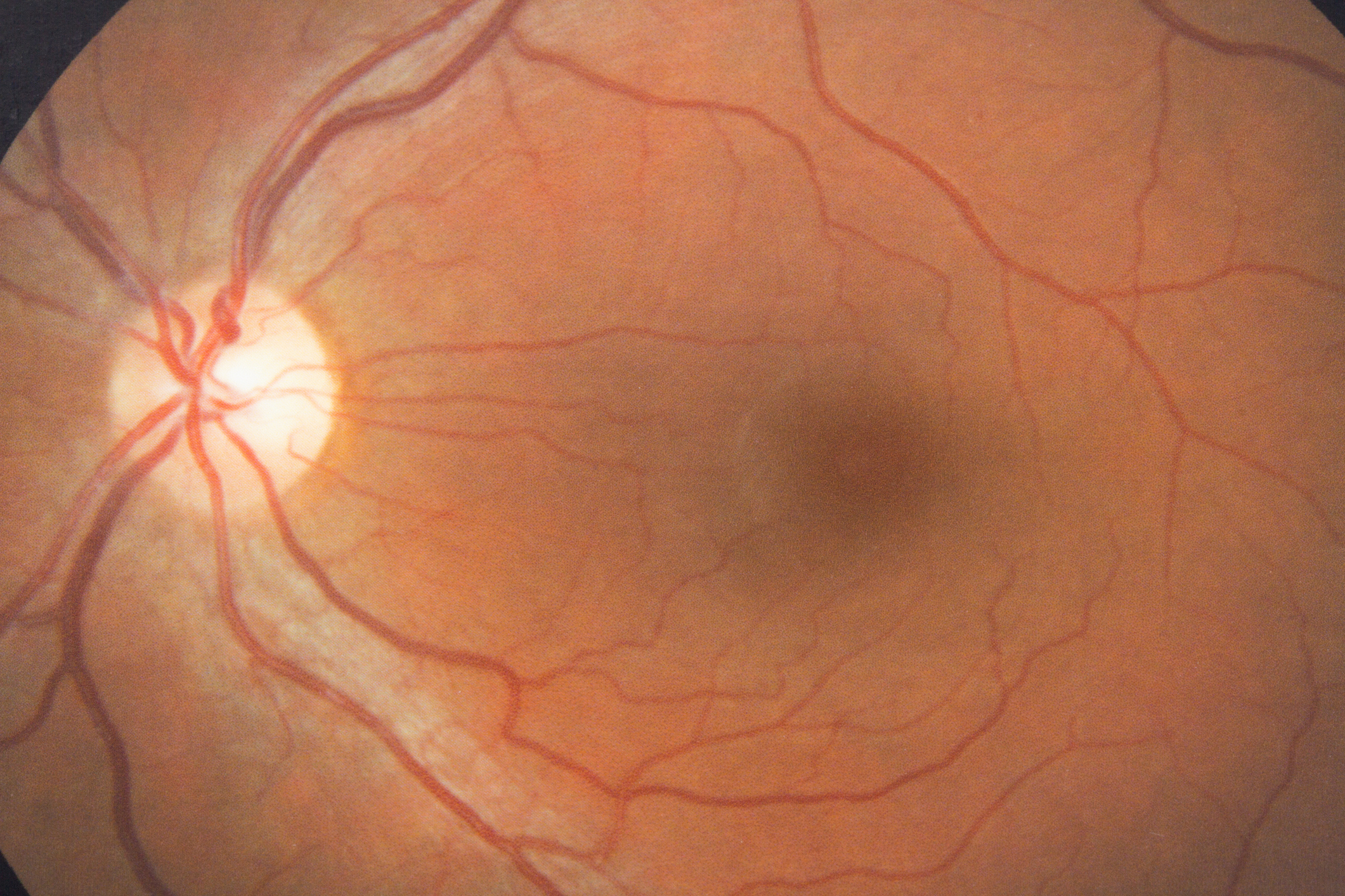 Retinal Degeneration