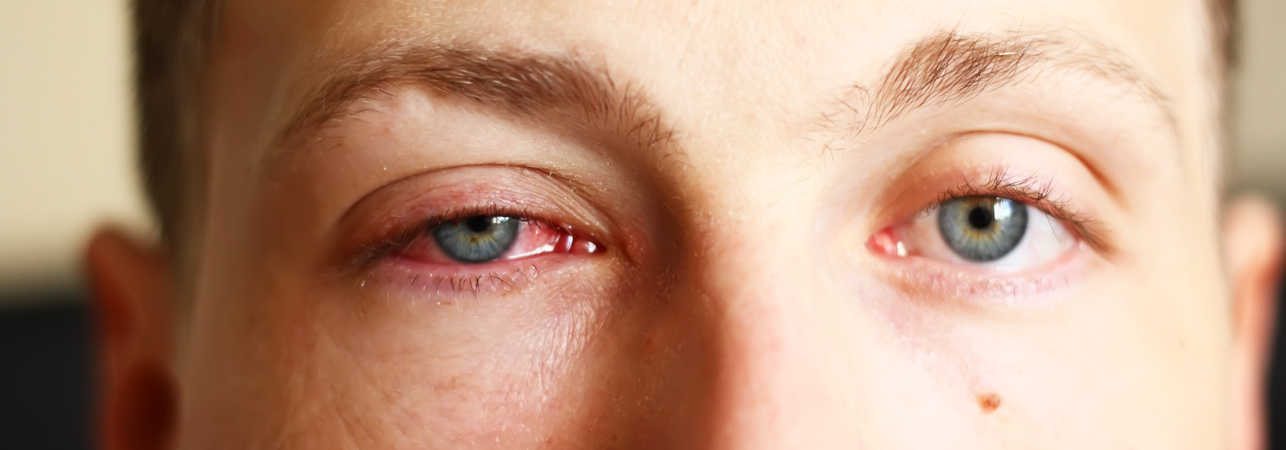 Conjuntivitis Bacteriana