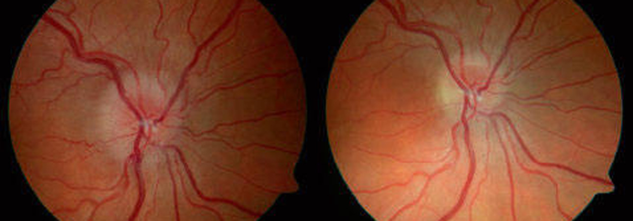 Atrophies optiques héréditaires