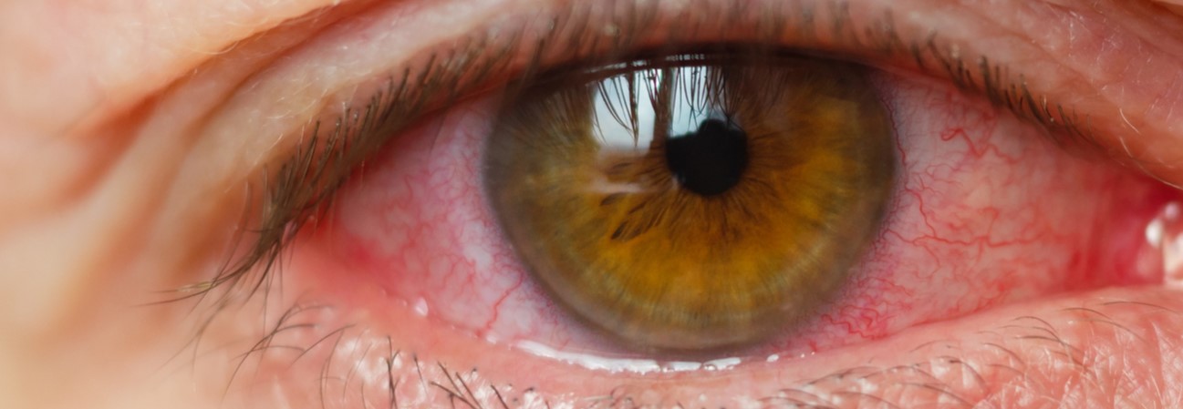 Infections de l'oeil