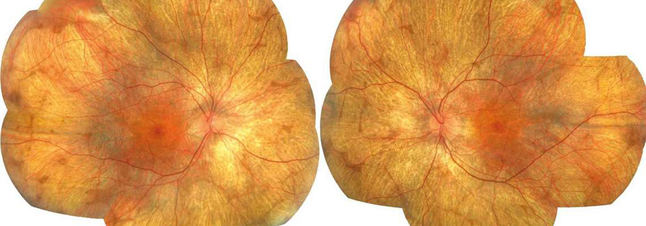 Coroideremia