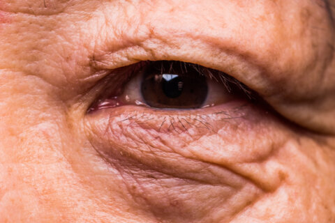 Age-related macular degeneration (AMD)