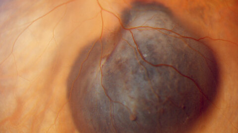 Uveal melanoma