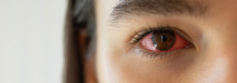 Infectious conjunctivitis